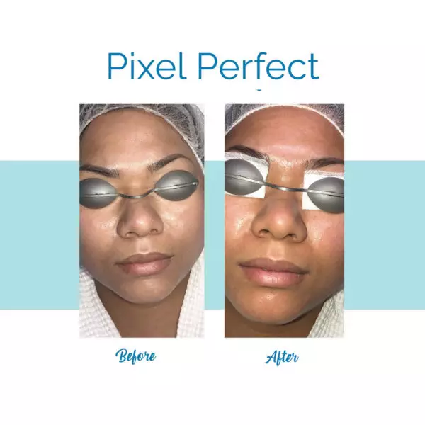 Pixel Perfect Laser Facial - Before & After