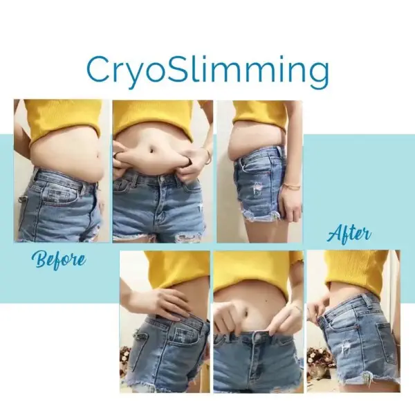 Bella Medpa is the Buckhead and Alpharetta leader in CryoSlimming body contouring and skin tightening