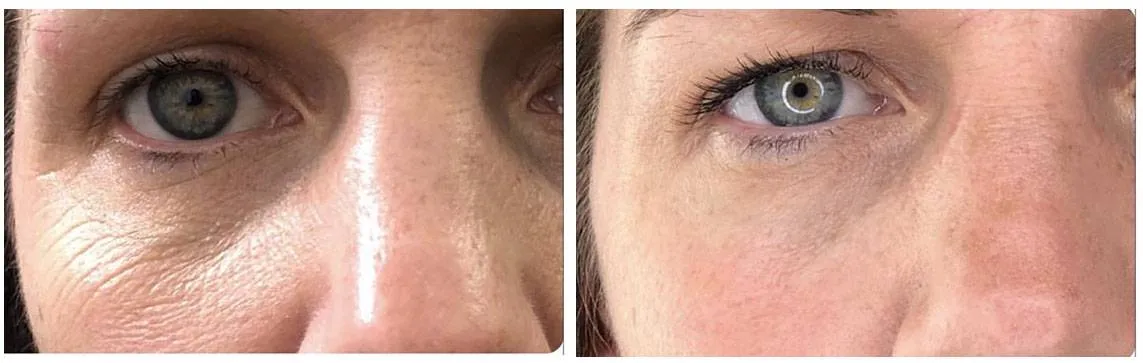 The Powerful Plasma Pen - Bella Medspa