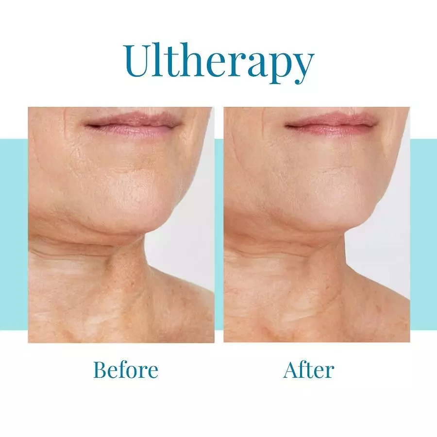 Bella Medspa offers Ultherapy treatments in Buckhead