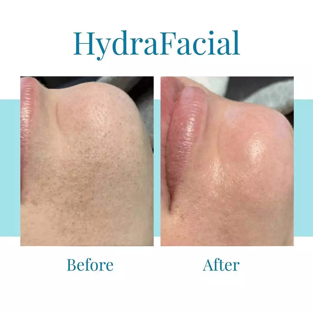 Bella Medspa in Buckhead and Alpharetta can treat all skin types with HydraFacial