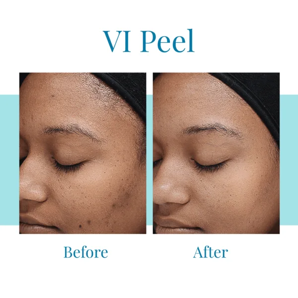 For a VI Peel in Buckhead or Alpharetta, trust Bella Medspa