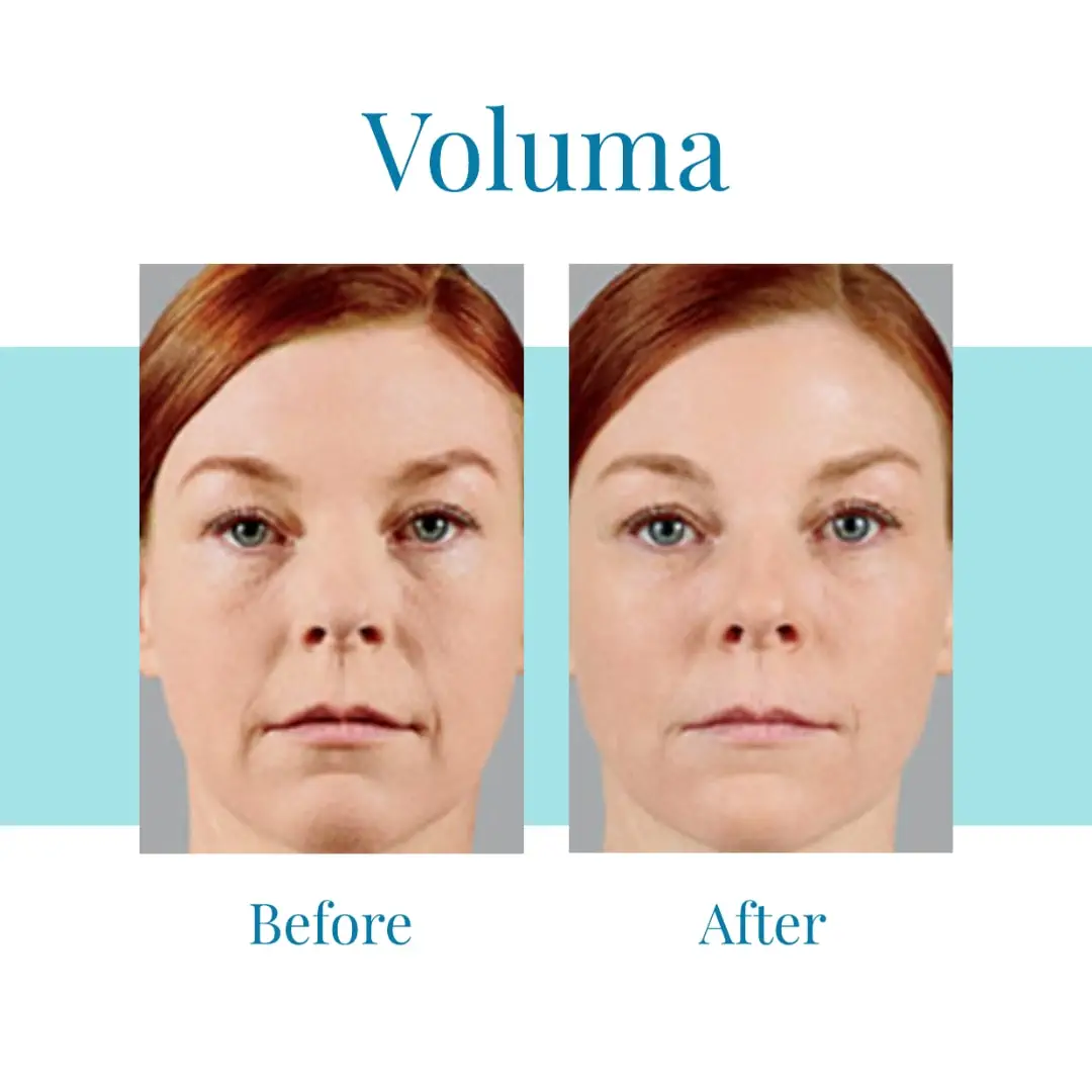 Bella Medspa is the leading provider of Juvéderm Voluma in greater Atlanta