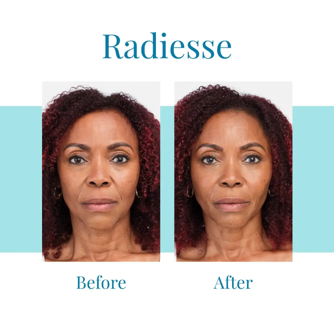 Bella Medspa is the leading provider of Radiesse in Alpharetta and Buckhead