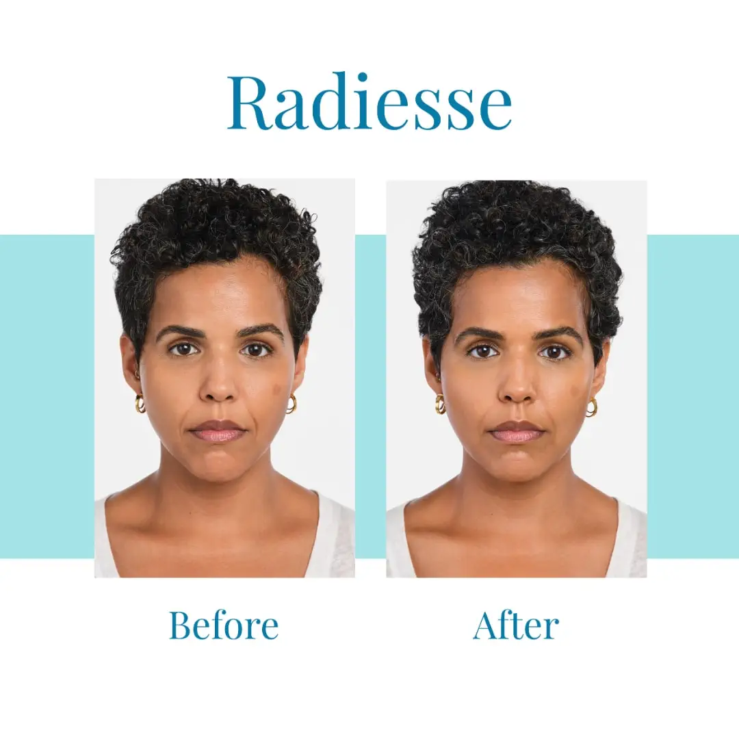 For Radiesse in Buckhead or Alpharetta, trust Bella Medspa