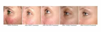 Ouchless Acne Facial- Before and After