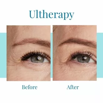 Bella Medspa offers Ultherapy in Buckhead