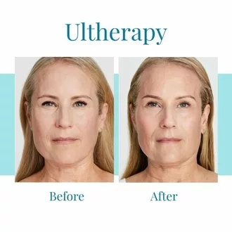 Bella Medspa offers Ultherapy treatments in Alpharetta