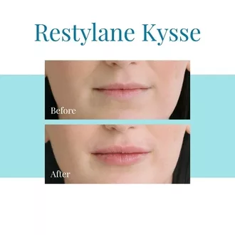 Bella Medspa is the top provider of Restylane Kysse injections in Alpharetta