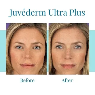Bella Medspa offers Juvederm Ultra Plus treatments in Buckhead