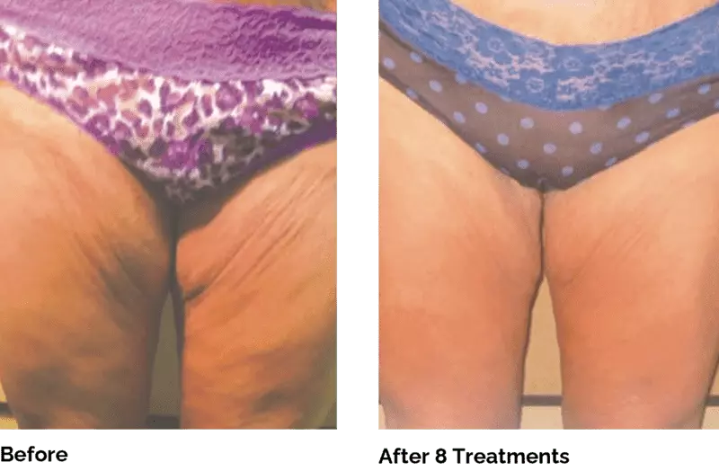 Venus Legacy in Buckhead and Alpharetta reduces fat and tightens the skin in the thighs