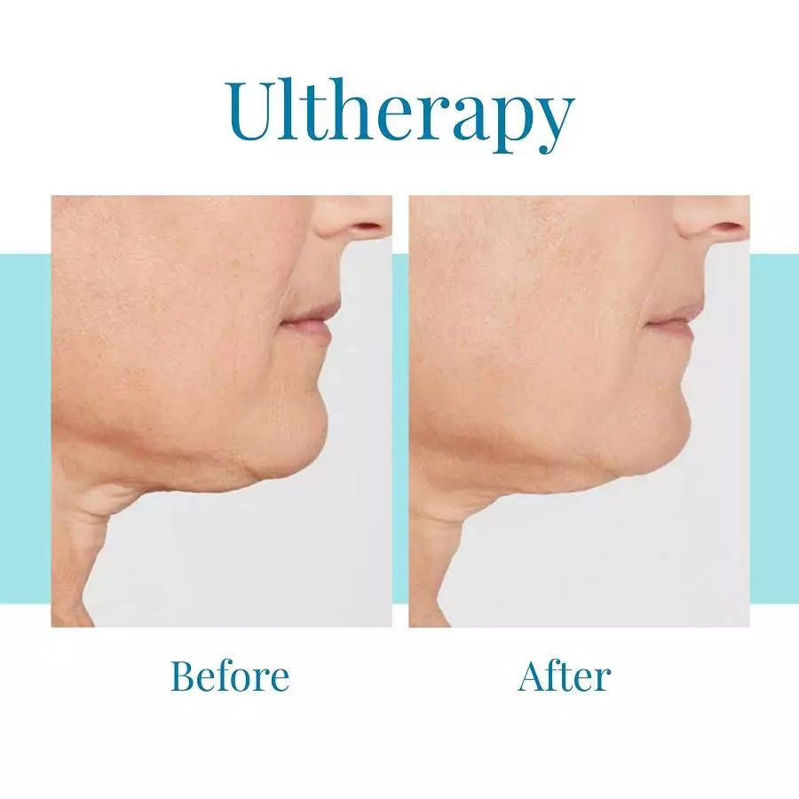 Bella Medspa is the leading Ultherapy provider in Alpharetta and Buckhead