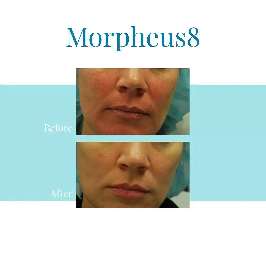 Bella Medspa is the top provider of Morpheus8 in Buckhead